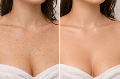 BELVIYA- Anti-Keratosis Pilaris Peelingtuch